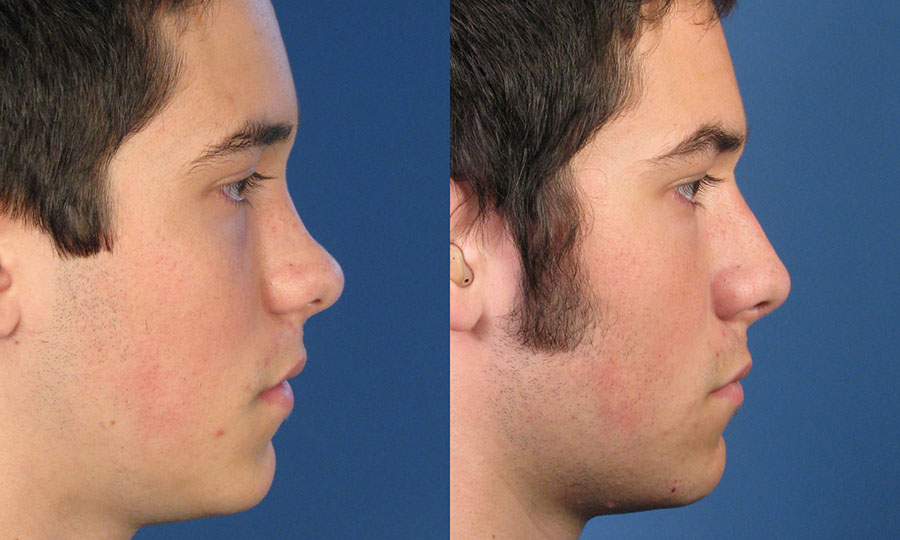 2406 Saddle Nose Deformity.jpg