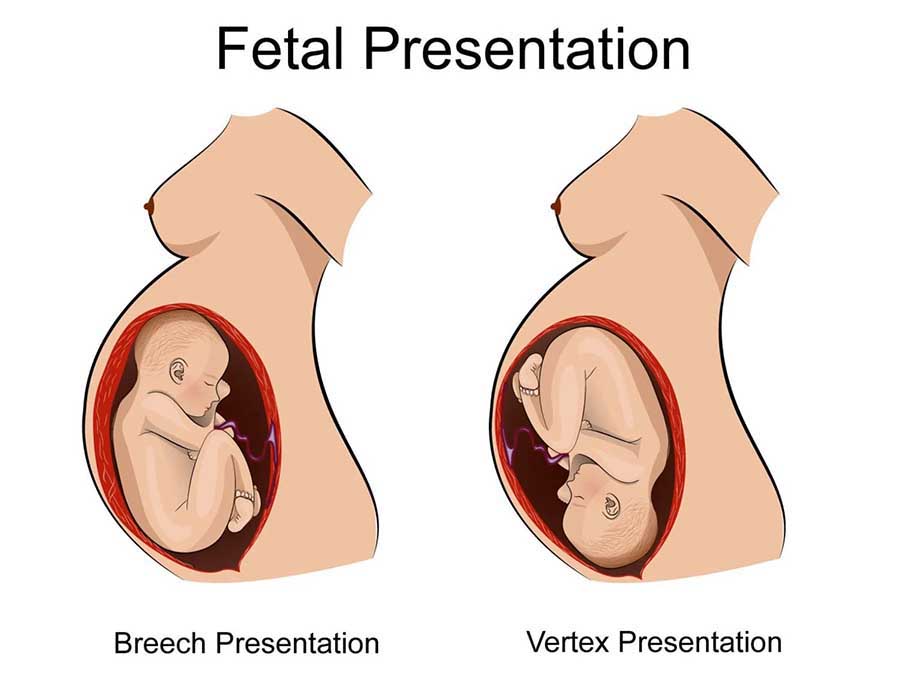 2407 Fetal presentation.jpg