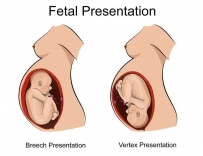 2407 Fetal presentation